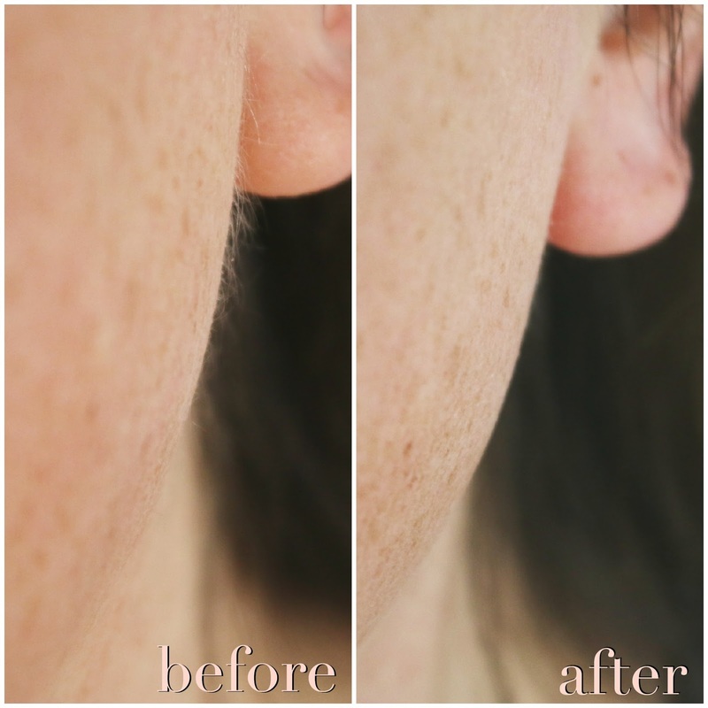 dermaplaning before and after photos best skin treatment cosmetic center tampa florida